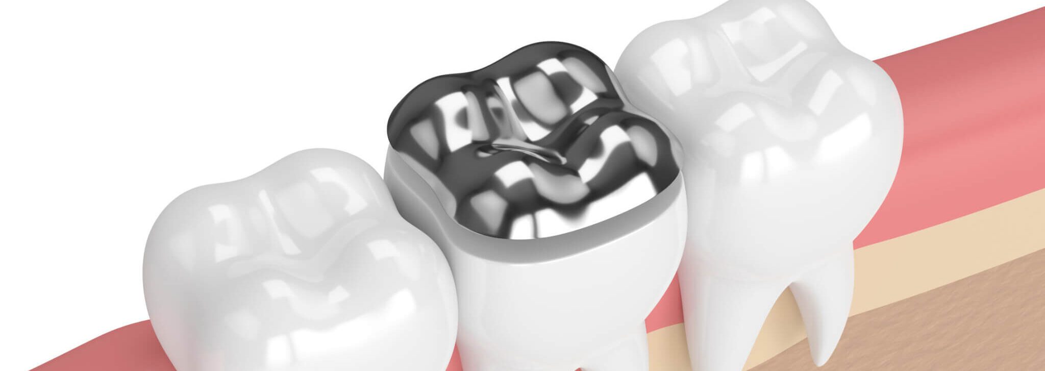 Planning on Removing Amalgam Fillings Side Effects to Note